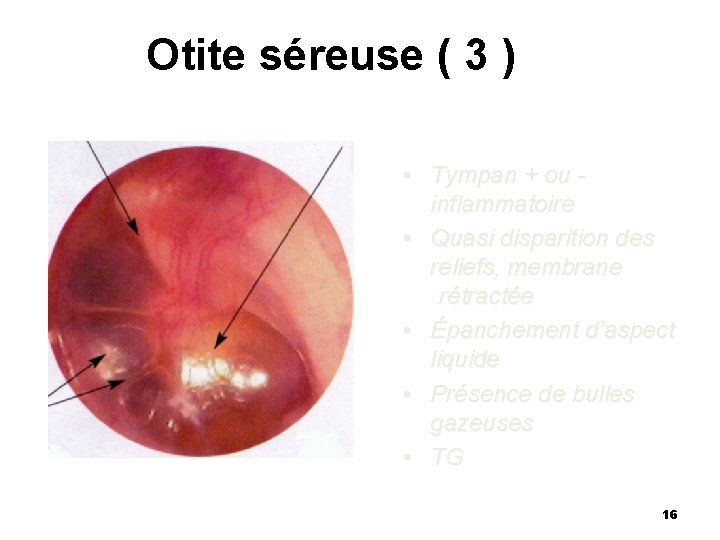 Otite séreuse ( 3 ) • Tympan + ou inflammatoire • Quasi disparition des Otite séreuse ( 3 ) • Tympan + ou inflammatoire • Quasi disparition des