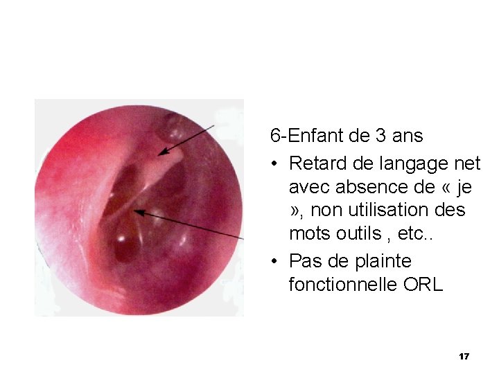 6 -Enfant de 3 ans • Retard de langage net avec absence de «