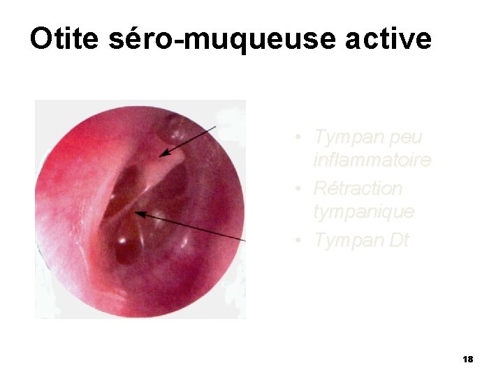 Otite séro-muqueuse active • Tympan peu inflammatoire • Rétraction tympanique • Tympan Dt 18 Otite séro-muqueuse active • Tympan peu inflammatoire • Rétraction tympanique • Tympan Dt 18