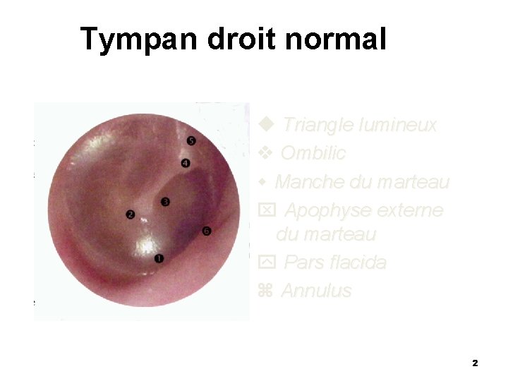 Tympan droit normal Triangle lumineux Ombilic Manche du marteau Apophyse externe du marteau Pars