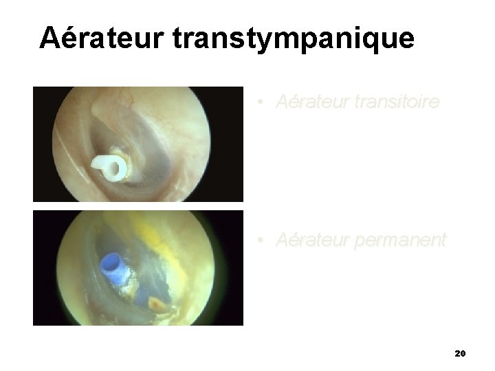 Aérateur transtympanique • Aérateur transitoire • Aérateur permanent 20 