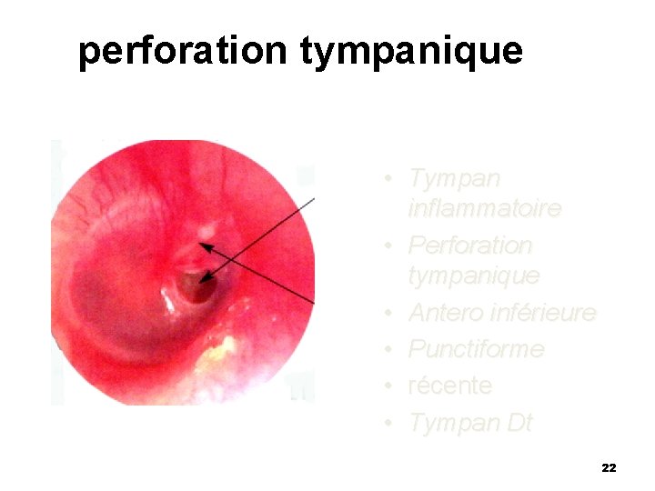 perforation tympanique • Tympan inflammatoire • Perforation tympanique • Antero inférieure • Punctiforme •