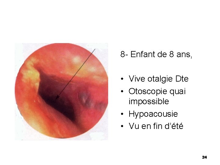 8 - Enfant de 8 ans, • Vive otalgie Dte • Otoscopie quai impossible