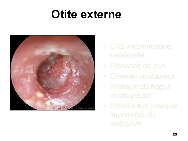 Otite externe • CAE inflammatoire, oedématié • Présence de pus • Examen douloureux •