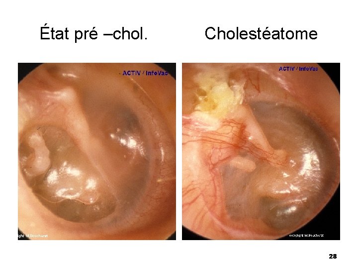 État pré –chol. Cholestéatome 28 État pré –chol. Cholestéatome 28