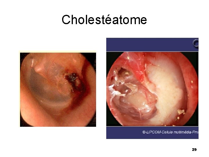 Cholestéatome 29 Cholestéatome 29