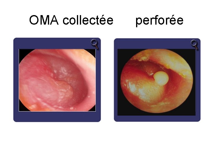 OMA collectée perforée 