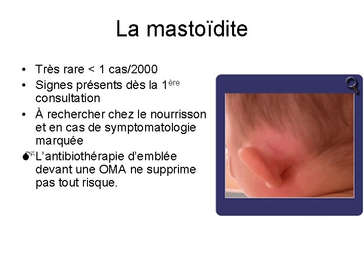 La mastoïdite • Très rare < 1 cas/2000 • Signes présents dès la 1ère