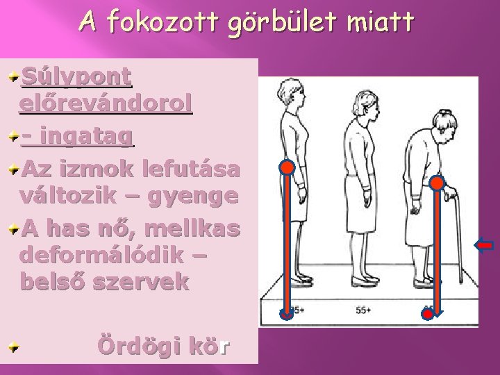 A fokozott görbület miatt Súlypont előrevándorol - ingatag Az izmok lefutása változik – gyenge