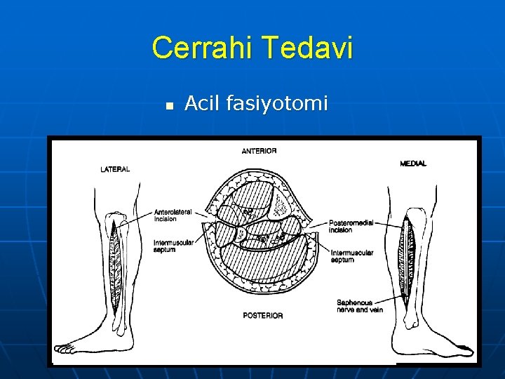 Cerrahi Tedavi n Acil fasiyotomi 