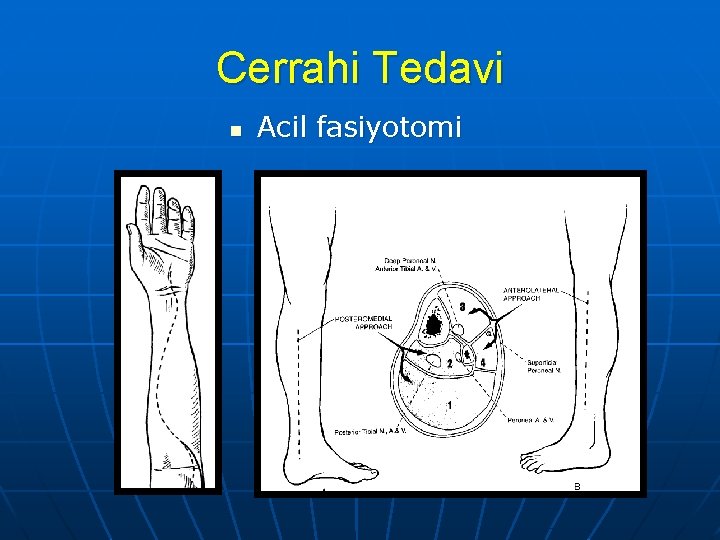 Cerrahi Tedavi n Acil fasiyotomi 