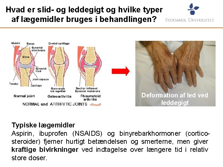 Hvad er slid- og leddegigt og hvilke typer af lægemidler bruges i behandlingen? Deformation