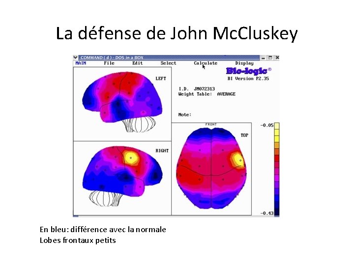 La défense de John Mc. Cluskey En bleu: différence avec la normale Lobes frontaux