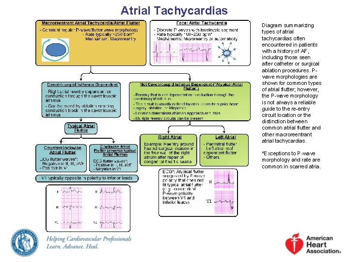 Atrial Tachycardias Diagram summarizing types of atrial tachycardias often encountered in patients with a