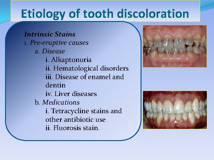 Etiology of tooth discoloration Intrinsic Stains 1. Pre-eruptive causes a. Disease i. Alkaptonuria ii.