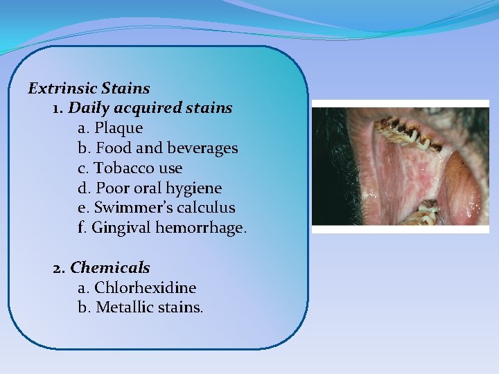 Extrinsic Stains 1. Daily acquired stains a. Plaque b. Food and beverages c. Tobacco