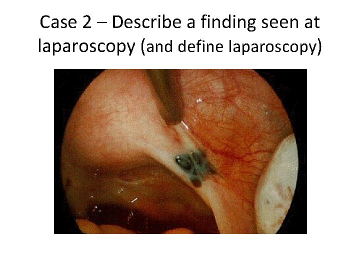 Case 2 – Describe a finding seen at laparoscopy (and define laparoscopy) 