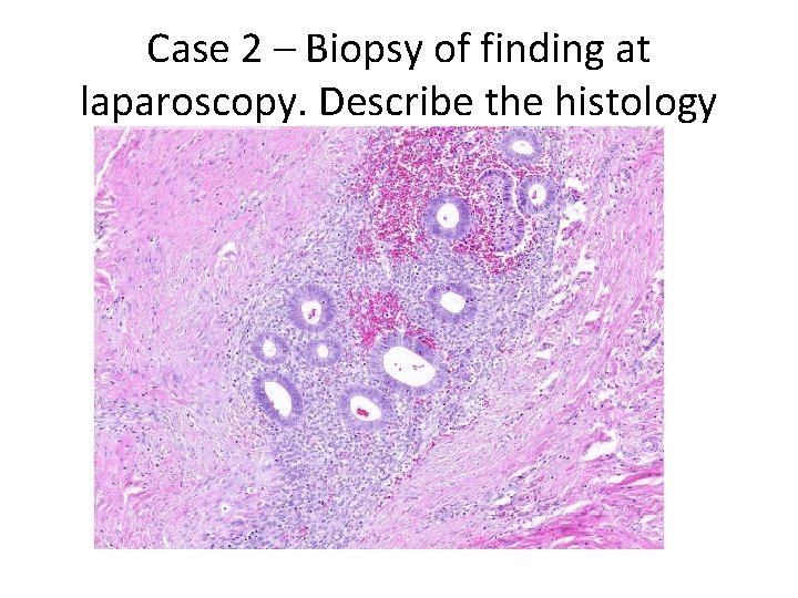 Case 2 – Biopsy of finding at laparoscopy. Describe the histology 
