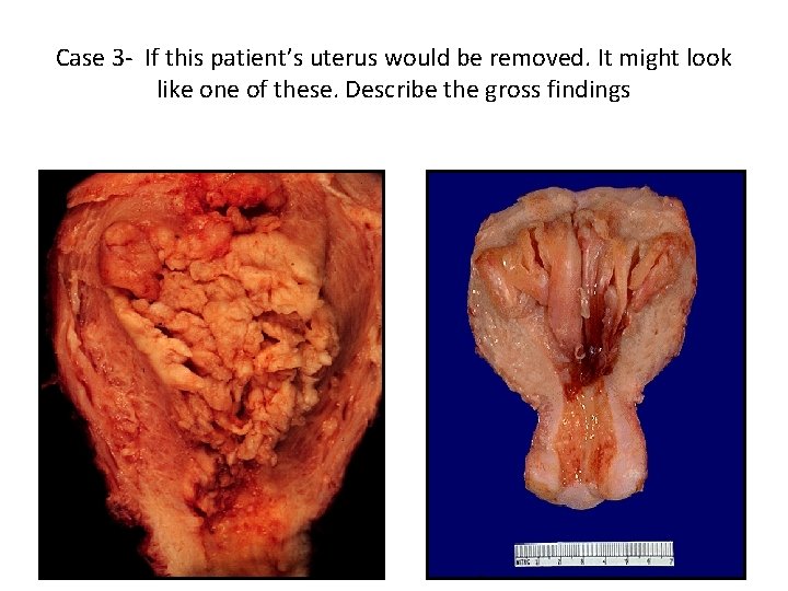 Case 3 - If this patient’s uterus would be removed. It might look like