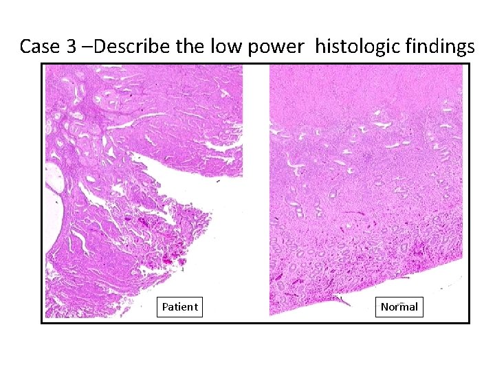 Case 3 –Describe the low power histologic findings Patient Normal 