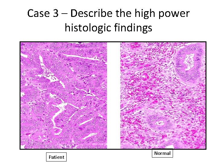 Case 3 – Describe the high power histologic findings Patient Normal 