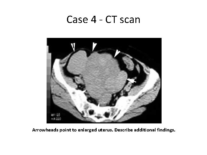 Case 4 - CT scan Arrowheads point to enlarged uterus. Describe additional findings. 