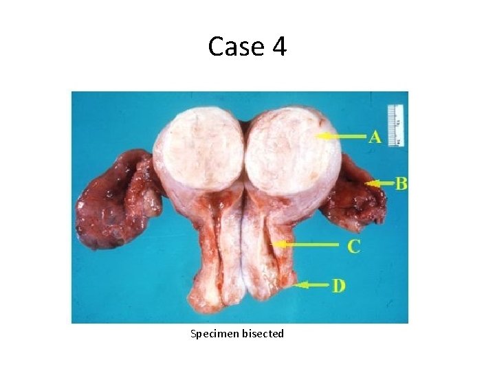 Case 4 Specimen bisected 