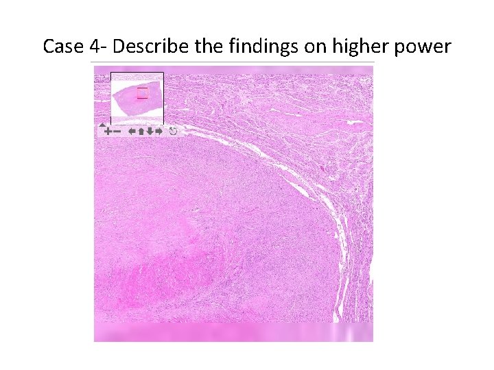 Case 4 - Describe the findings on higher power 