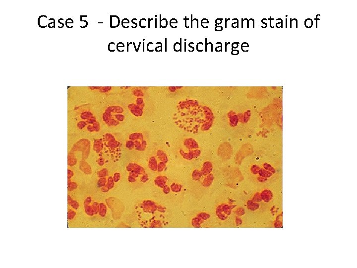 Case 5 - Describe the gram stain of cervical discharge 