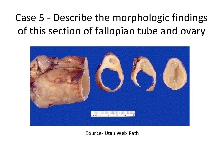 Case 5 - Describe the morphologic findings of this section of fallopian tube and