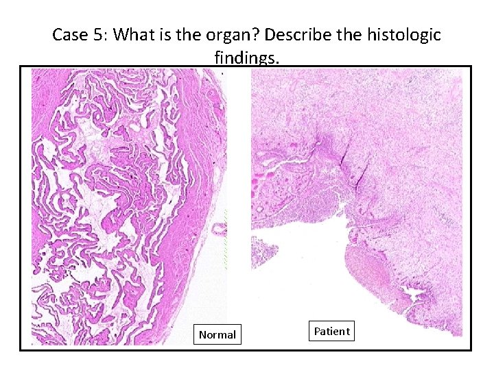 Case 5: What is the organ? Describe the histologic findings. Normal Patient 
