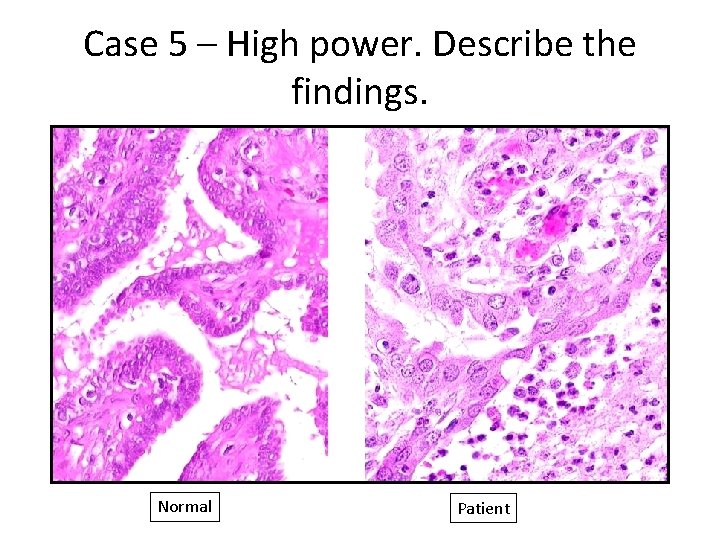 Case 5 – High power. Describe the findings. Normal Patient 