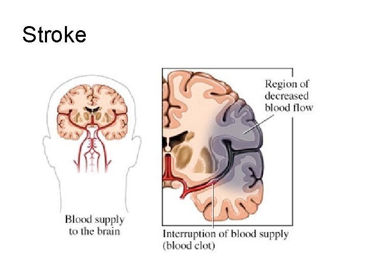Stroke Stroke