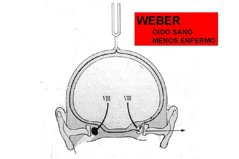 WEBER OIDO SANO MENOS ENFERMO 