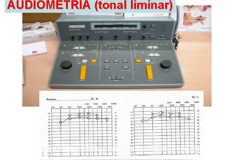 AUDIOMETRÍA (tonal liminar) 