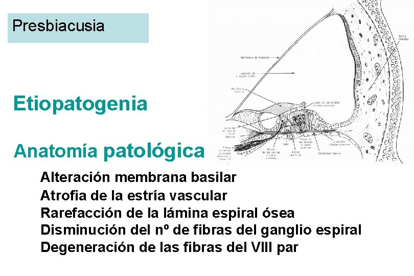 Presbiacusia Etiopatogenia Anatomía patológica Alteración membrana basilar Atrofia de la estría vascular Rarefacción de