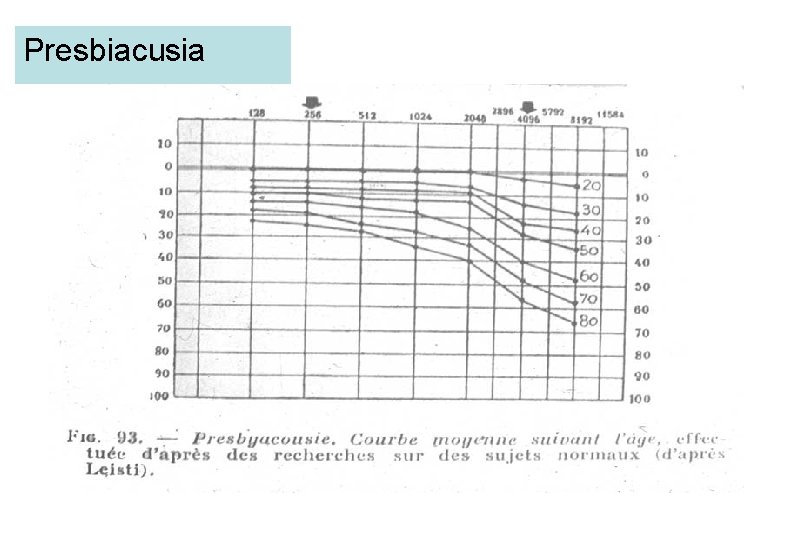 Presbiacusia 