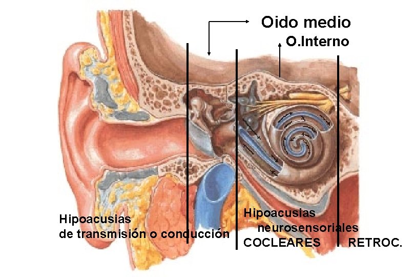 Oido medio O. Interno Hipoacusias de transmisión o conducción Hipoacusias neurosensoriales COCLEARES RETROC. 