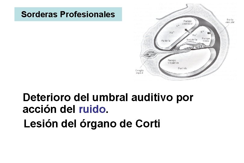 Sorderas Profesionales Deterioro del umbral auditivo por acción del ruido. Lesión del órgano de