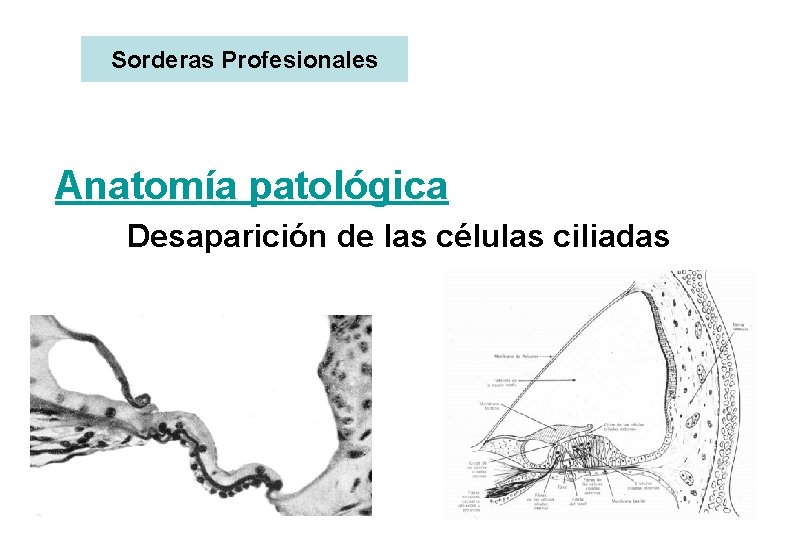 Sorderas Profesionales Anatomía patológica Desaparición de las células ciliadas 