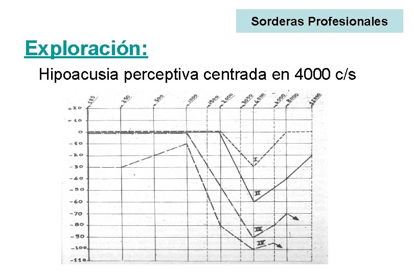 Sorderas Profesionales Exploración: Hipoacusia perceptiva centrada en 4000 c/s 