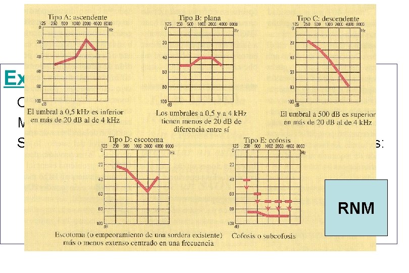 Sordera brusca Exploración Curva audiométrica horizontal Marcada inclinación en los agudos Según la pérdida