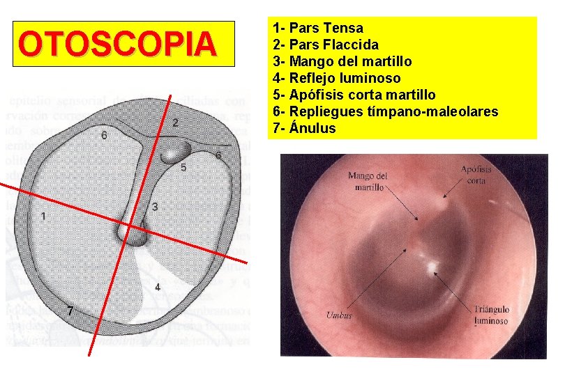 OTOSCOPIA 7 1 - Pars Tensa 2 - Pars Flaccida 3 - Mango del