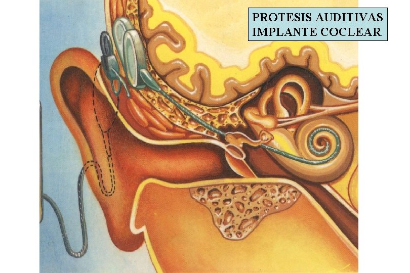 PROTESIS AUDITIVAS IMPLANTE COCLEAR 