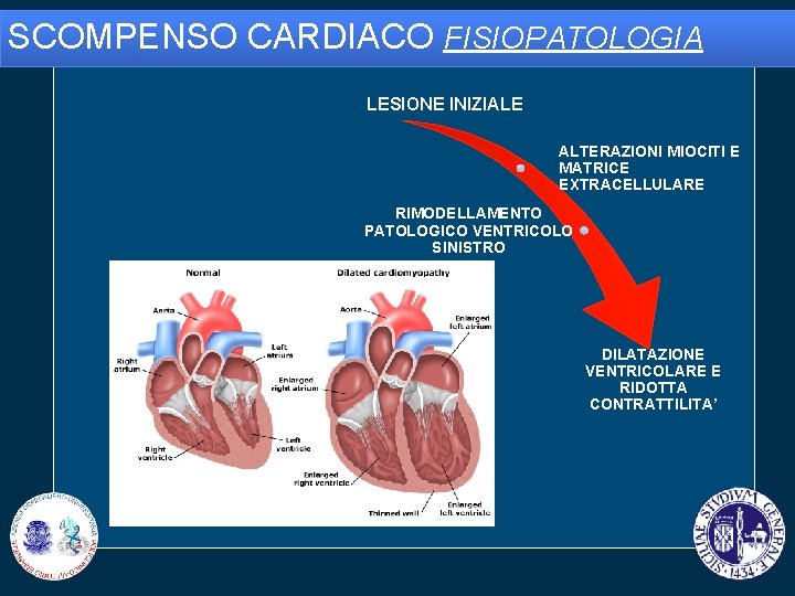 SCOMPENSO CARDIACO FISIOPATOLOGIA LESIONE INIZIALE ALTERAZIONI MIOCITI E MATRICE EXTRACELLULARE RIMODELLAMENTO PATOLOGICO VENTRICOLO SINISTRO
