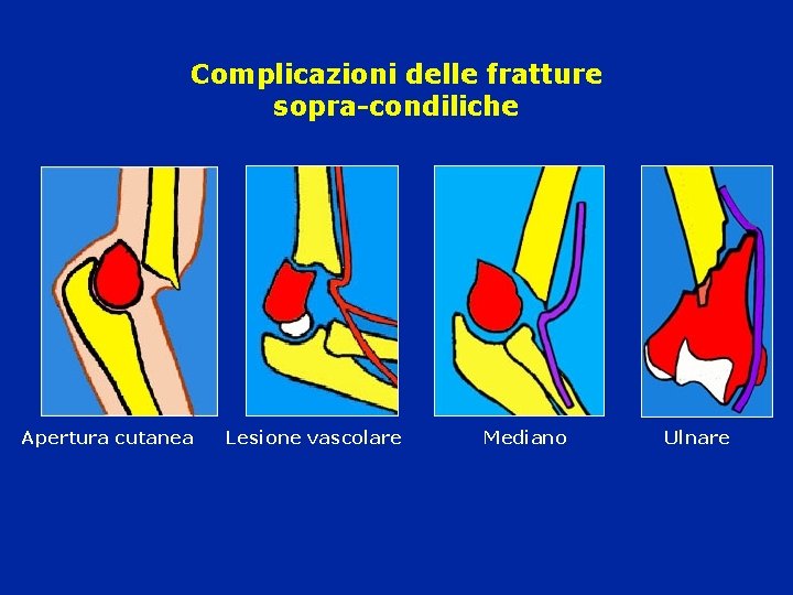 Complicazioni delle fratture sopra-condiliche Apertura cutanea Lesione vascolare Mediano Ulnare 