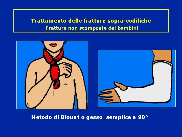 Trattamento delle fratture sopra-codiliche Fratture non scomposte dei bambini Metodo di Blount o gesso