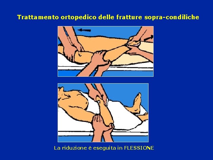 Trattamento ortopedico delle fratture sopra-condiliche La riduzione è eseguita in FLESSIONE 