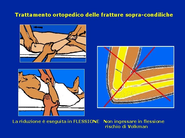 Trattamento ortopedico delle fratture sopra-condiliche La riduzione è eseguita in FLESSIONE Non ingessare in
