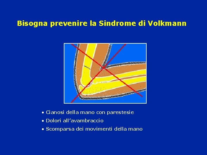 Bisogna prevenire la Sindrome di Volkmann • Cianosi della mano con parestesie • Dolori